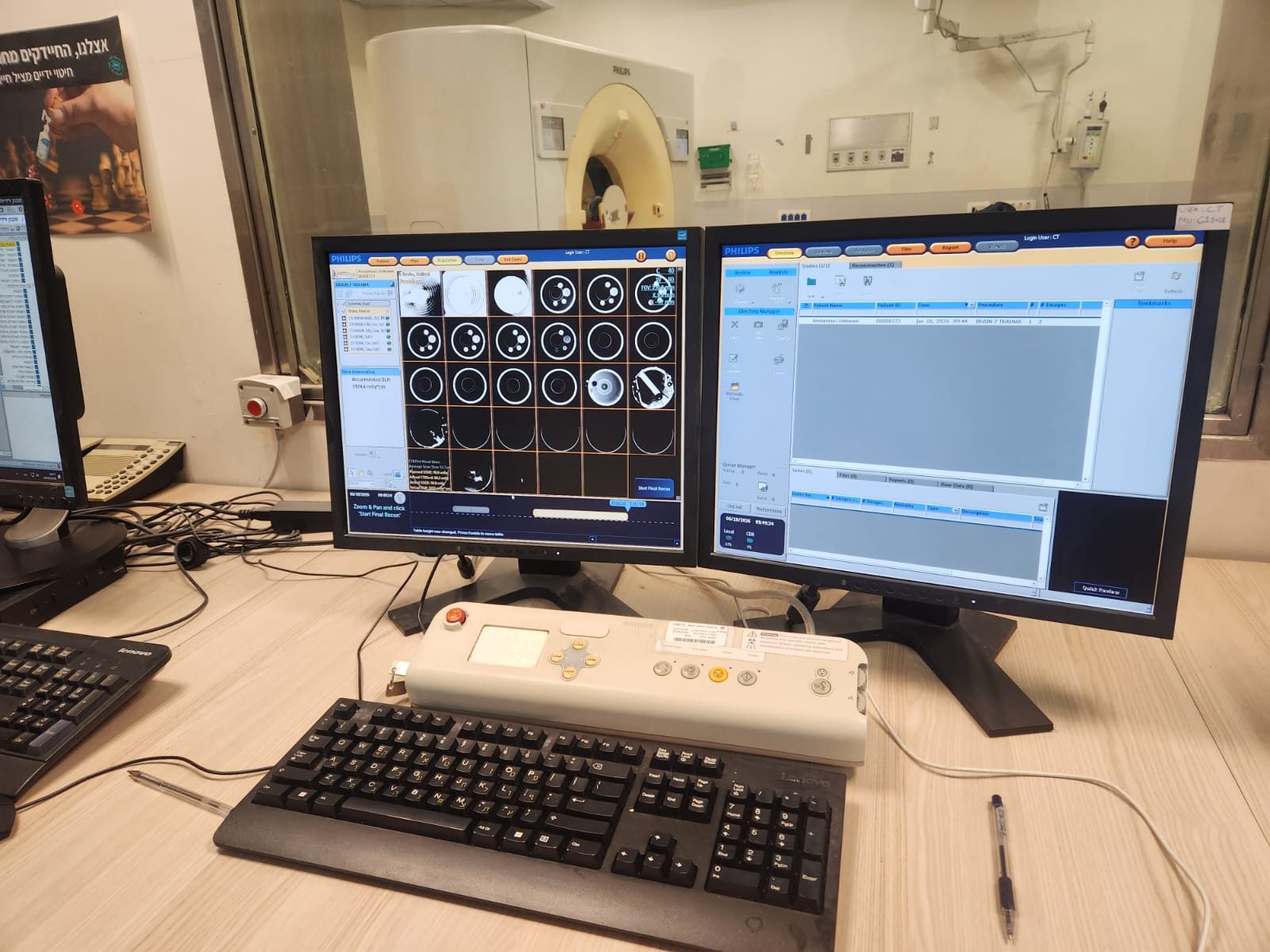 Philips Brilliance iCT 256 axial brain trauma reconstruction series displayed on Philips operator console